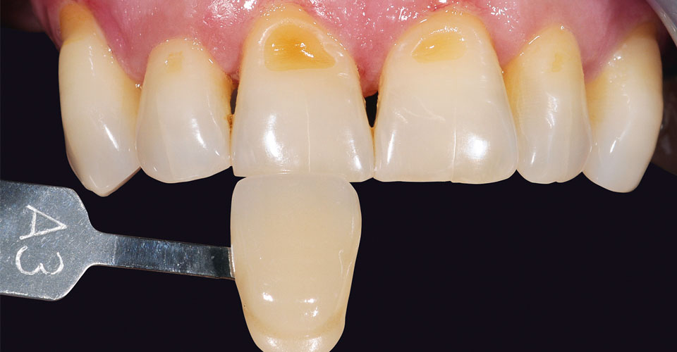 Fig. 3: Diente medido y varilla de color en el color determinado por el VITA Easyshade V.
