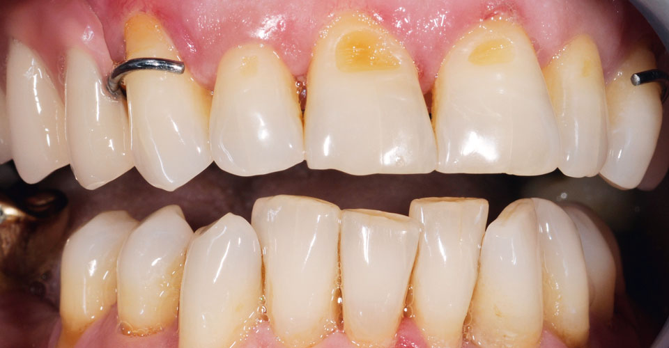 Fig. 6: El color dental y la morfologÃa armonizaron con la dentadura remanente.