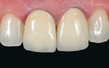 Fig. 1: Initially, the metal-ceramic crowns on teeth 11 and 21 showed esthetic deficits.