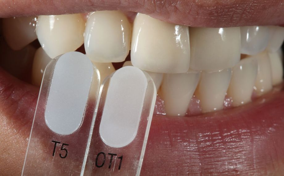 Fig. 4: The translucent shade nuances were determined using the VITA VMK Master TRANSLUCENT shade guides.