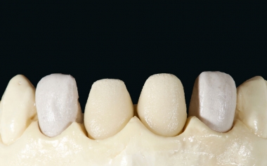 Fig. 8: The first dentine firing was performed with VITA VMK Master LUMINARY 1 (white) and 4 (light brown-orange).