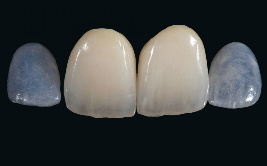 Fig. 12: The final result after further preparation, character­ization and glazing with VITA AKZENT Plus and polishing.