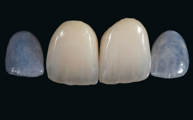 Fig. 12: The final result after further preparation, character­ization and glazing with VITA AKZENT Plus and polishing.