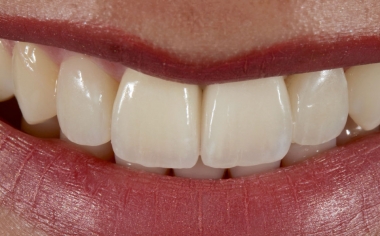 Fig. 13: The symmetrical edges of the incisors harmonized with the curve of the lip.