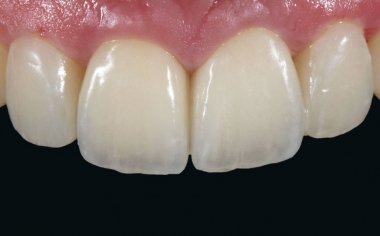 Fig. 14: The two different types of restorations showed lively light effects.