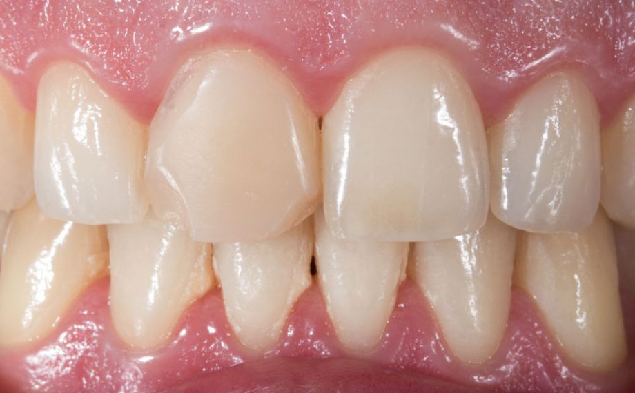 Fig. 1: La obturación de composite insuficiente y fracturada en el diente 11 debía tratarse con una corona de cerámica de feldespato confeccionada mediante CAD/CAM.