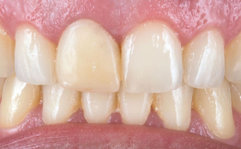 Fig. 2: Como solución rápida se confeccionó mediante CAD/CAM una corona de composite provisional de VITA CAD-Temp multiColor.