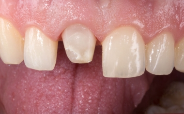 Fig. 3: Durante la preparación del diente 11 se retiró casi por completo la obturación de composite.
