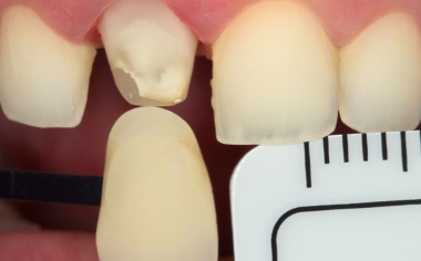 Fig. 8: Una fotografía digital con filtro polarizador y la varilla de colores seleccionada proporcionó información individualizada al protésico dental.