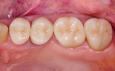 Fig. 6: Examen de partida; coronas de cerámica sin metal VITABLOCS (24–27).