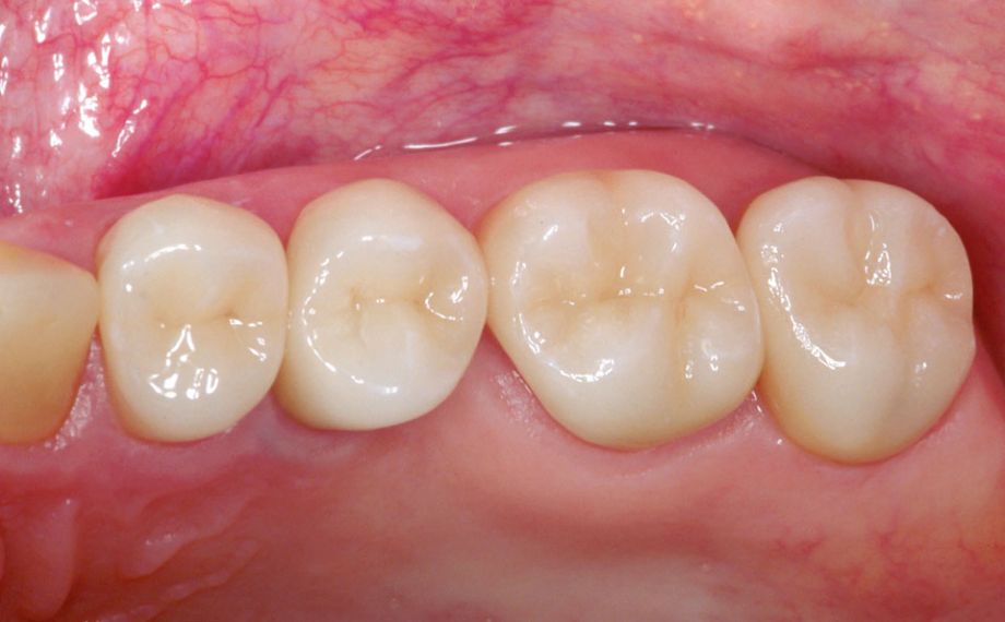 Fig. 8: Coronas de VITABLOCS, control de seguimiento al cabo de 20,5 años.
Fuente de la imagen: Dr. Andreas Bindl, profesor agregado (Zúrich, Suiza)