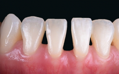 Fig. 1: La situación de partida con un diastema pronunciado entre los dos incisivos centrales inferiores.