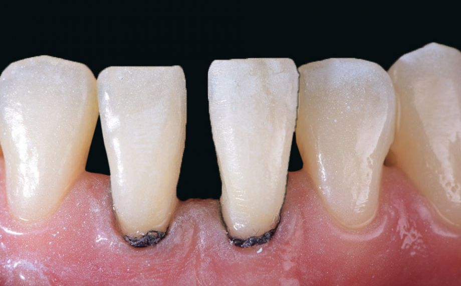 Fig. 3: Antes del escaneo intraoral se colocaron hilos de retracción para hacer escaneable también la zona cervical.