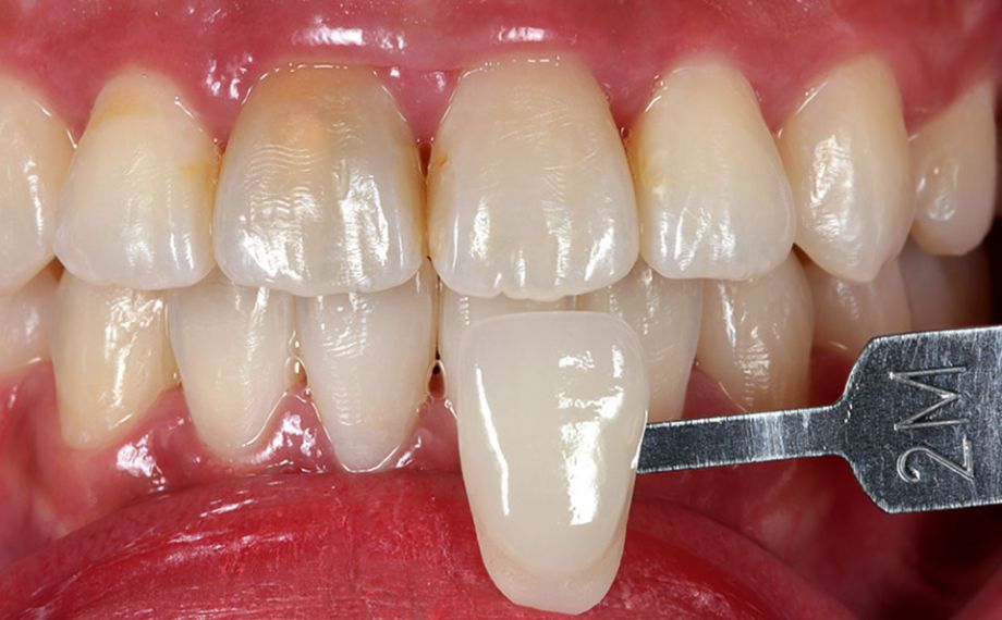 Fig. 3: Una fotografía digital con la correspondiente varilla de colores proporcionó información individualizada a la protésica dental.