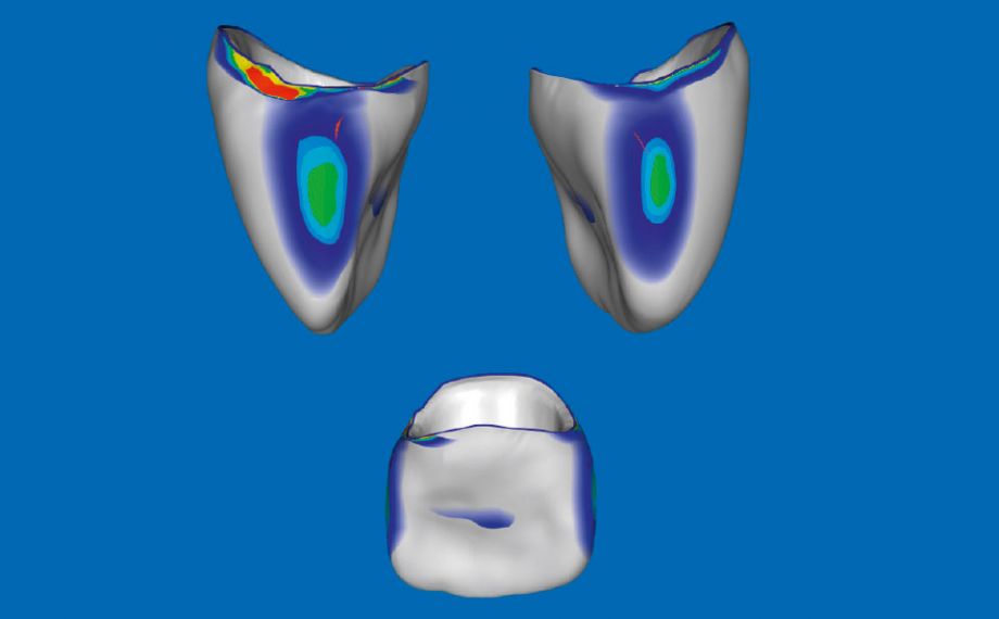 Fig. 5: En el software CEREC Premium 4.4.4 se pudieron modificar las zonas de punto de contacto oclusales y proximales.