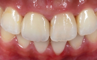 Fig. 10: Resultado: Mediante el posicionamiento y la rotación de la corona en el VITABLOCS TriLuxe forte multicromático se pudieron reproducir la translucidez y la transición cromática. 