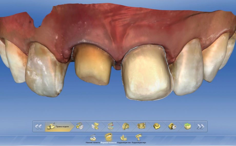 Fig. 4: Los límites de la preparación en los dientes 11 y 21 se establecieron en el software CEREC.