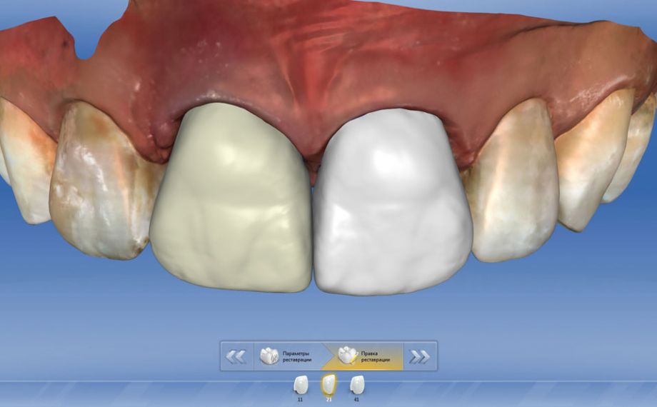 Fig. 5: En el diente 11 se diseñó una corona completa de VITA SUPRINITY PC, y en el 21 una carilla de VITABLOCS Mark II.