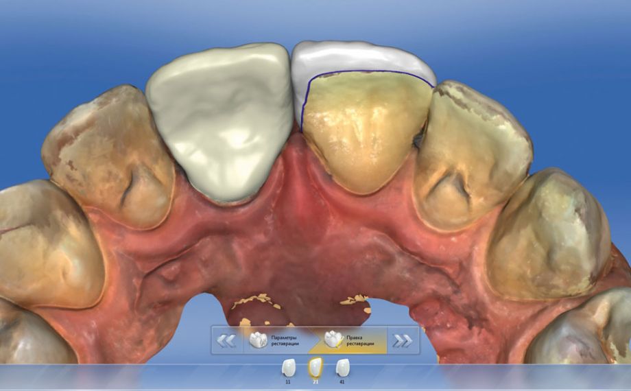 Fig. 6: Desde dorsal se aprecia virtualmente el borde palatino de la restauración con carilla.