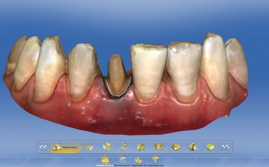Fig. 7: También para la preparación de la corona completa en el diente 41 se estableció digitalmente el límite de la preparación.