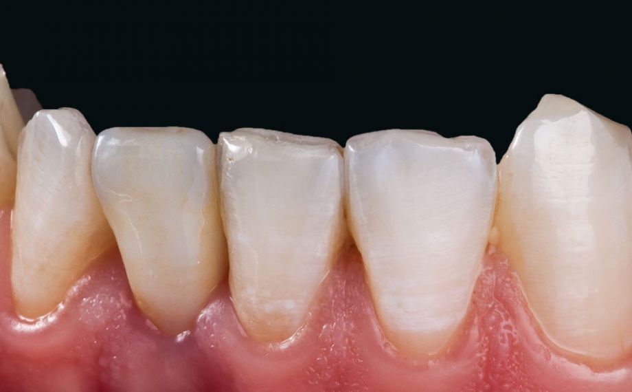 Fig. 12: La corona de cerámica sin metal de VITA SUPRINITY PC se integró de manera excelente en la sustancia dental remanente en cuanto a la morfología y el color.