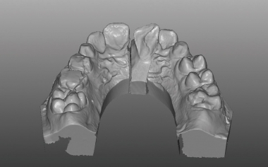Caso clinico 1Fig. 5: El recorrido palatino expuesto de la fractura tras la gingivectomía en el modelo virtual. 