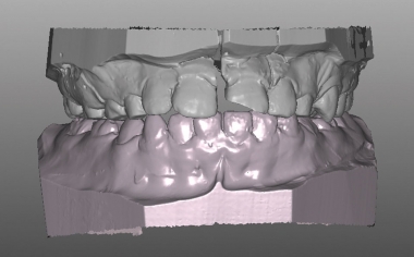 Caso clinico 1Fig. 6: La fractura longitudinal de la corona vista desde vestibular en el modelo maestro digitalizado. 