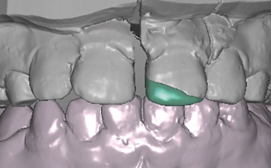 Caso clinico 1Fig. 10: También por vestibular, la restauración siguió el recorrido de la fractura. 