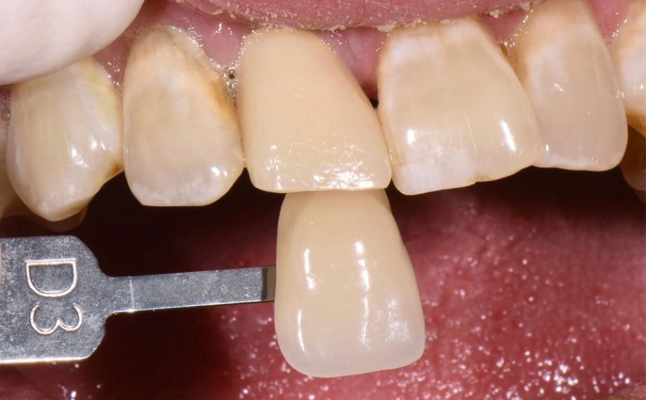 Fig. 2: El color dental básico se determinó mediante la guía de colores VITA classical A1–D4.