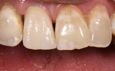 Fig. 3: El resultado tras la primera cocción de dentina durante la prueba clínica en boca.
