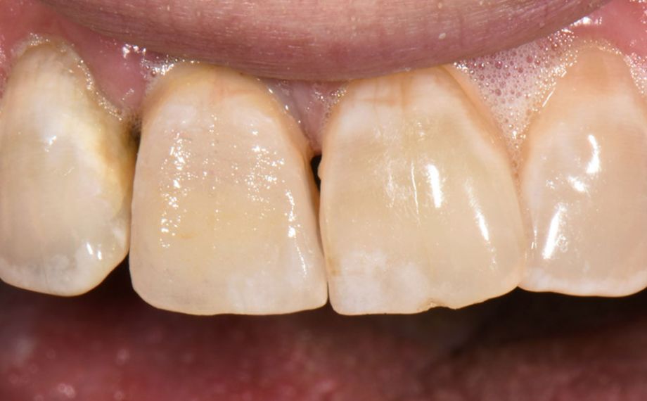 Fig. 5: La corona caracterizada y acabada durante la prueba clínica en boca. 