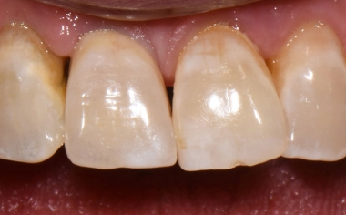 Fig. 7: La corona se integró estéticamente en la dentadura remanente natural.