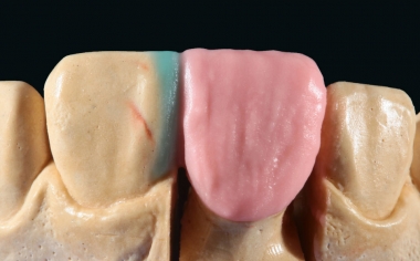 Fig. 5: Para completar el núcleo de dentina se estratificó adicionalmente con BASE DENTINE 1M1.