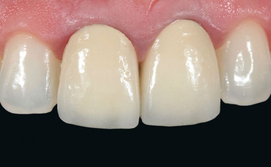 Fig. 1: En la situación de partida, las coronas metalocerámicas en los dientes 11 y 21 presentaban déficits estéticos.