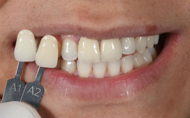 Fig. 2: El color dental básico A1 se determinó mediante la guía de colores VITA classical A1–D4.