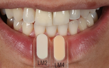 Fig. 3: Mediante las guías de colores VITA VMK Master LUMINARY se determinaron los efectos de fluorescencia.