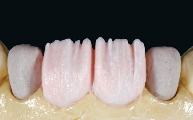 Fig. 9: El núcleo de dentina se estratificó con DENTINE A1 de manera reducida anatómicamente.
