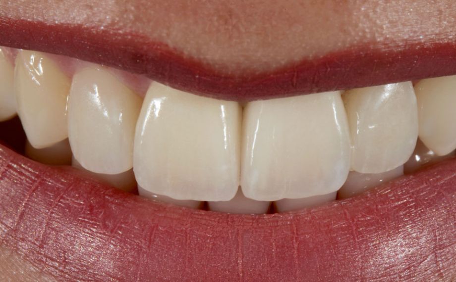 Fig. 13: Los bordes incisales simétricos armonizaban con el contorno de los labios.