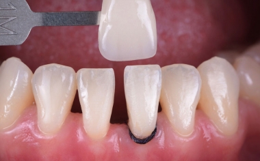 Ill. 2 : La détermination de la couleur de la dent à l'aide du VITA Toothguide 3D-MASTER recouvrait l'espace colori­-métrique et rendait possible un choix de bloc adapté.