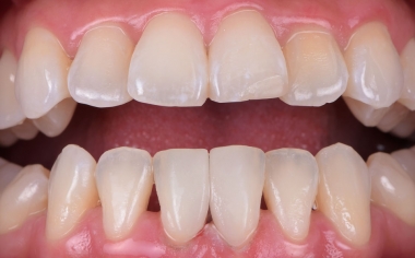 Ill. 7 : Les deux micro-facettes se rejoignaient de manière invisible dans la rangée de dents naturelles.
