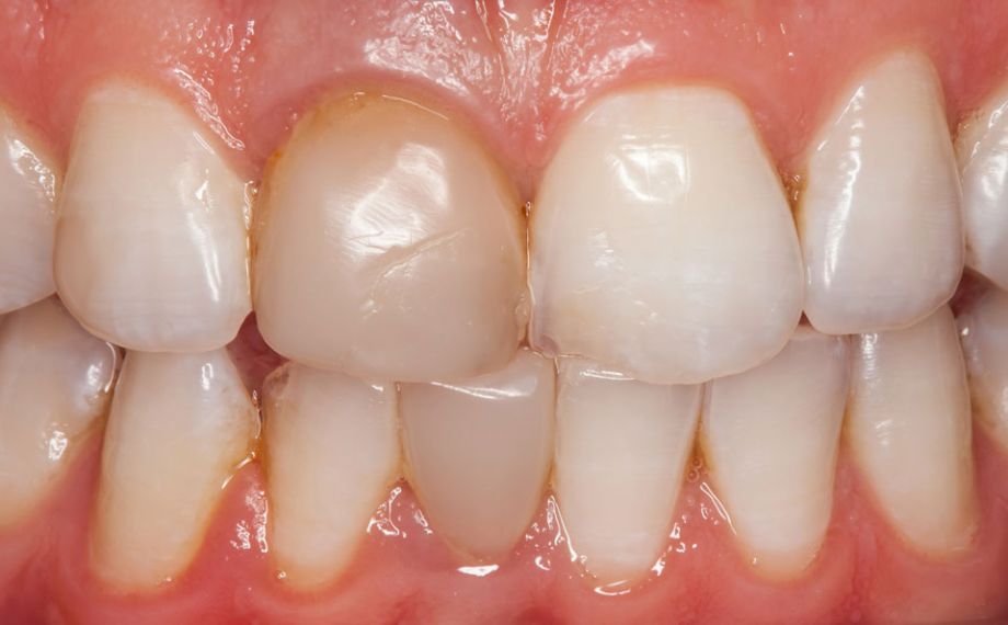 Ill. 1 : Situation initiale : Après le blanchiment précédant la pose de prothèse, il existait une différence de couleur visible entre la reconstruction en composite et la dentine.