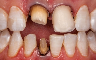 Ill. 3 : Après la préparation, des fils de rétraction ont été posés pour une détection optique optimale.