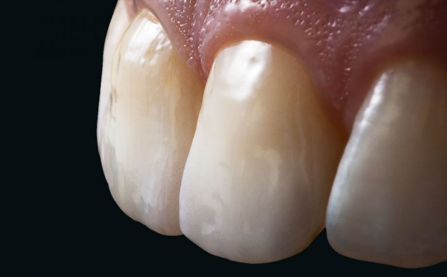 Ill. 13 : La morphologie et la texture de surface des deux restaurations en céramo-céramique ne pouvaient plus être différenciées des dents voisines naturelles.