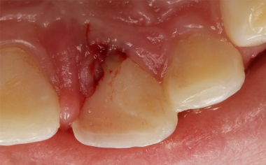 Exemple 1Ill. 3 : Le trait de fracture palatin s'étendait profondément dans la zone sous-gingivale.
