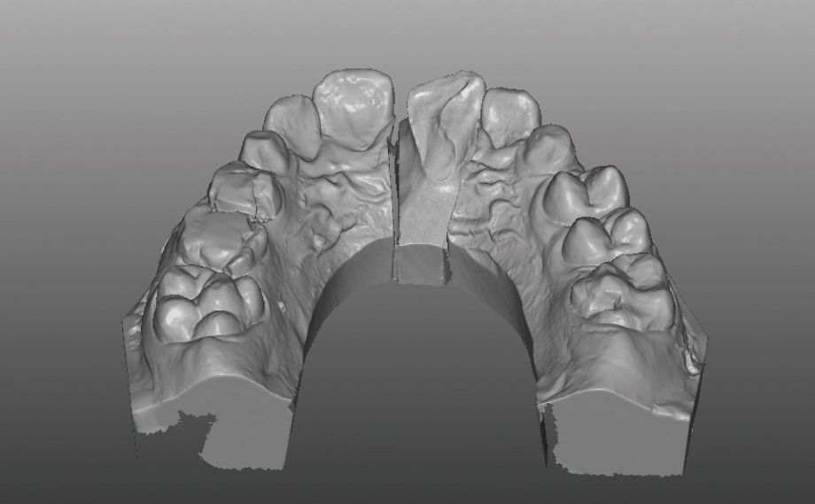 Exemple 1Ill. 5 : Trait de fracture palatin libéré après la gingivectomie dans le modèle virtuel.