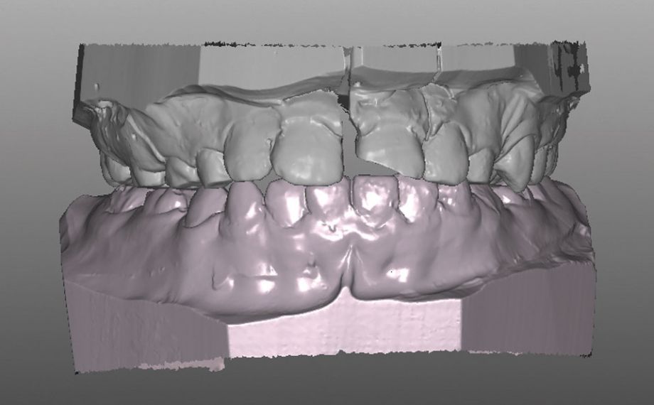 Exemple 1Ill. 6 : Fracture longitudinale de la couronne du vestibulaire dans le maître-modèle maître. 