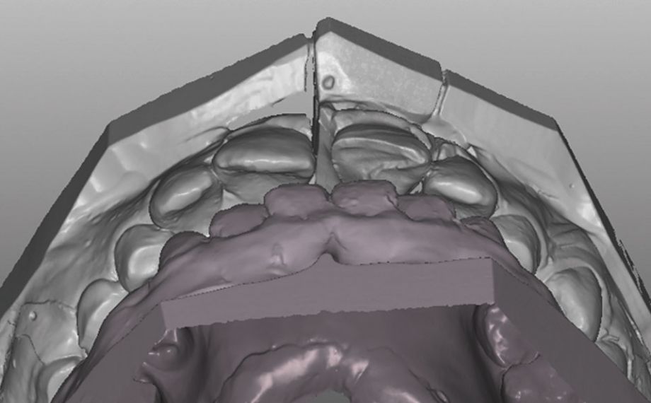 Exemple 1Ill. 7 : L'abrasion semblable à l'émail rend possible un guidage incisif fonctionnel durable sur la 21. 