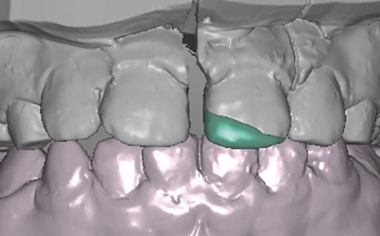 Exemple 1Ill. 10 : La restauration suivait le trait de fracture même en vestibulaire. 