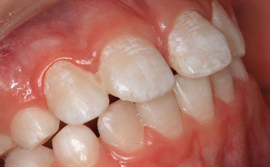 Exemple 1Ill. 12 : Résultat : Après la caractérisation avec VITA ENAMIC STAINS, la restauration s'insérait de manière harmonieuse. 
