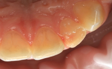 Exemple 2Ill. 1 : Situation initiale : Le trait de fracture palatin de la 22 servait de limite à la préparation orientée sur le défaut.